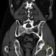 Osteolysis of sacrum: CT - Computed tomography